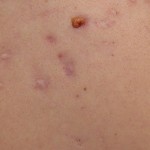 Ilustrasi penderita cacar monyet-1654511045