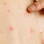 Penderita penyakit cacar monyet-1655021912