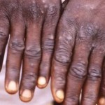 Cacar Monyet-1660961926